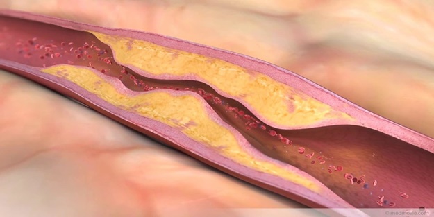 Kalp Damar tıkanıklığı neden olur? Tedavisi Varmıdır?
